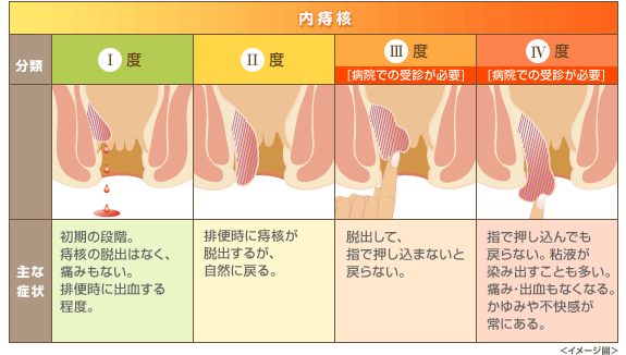 内痔核のイメージ図